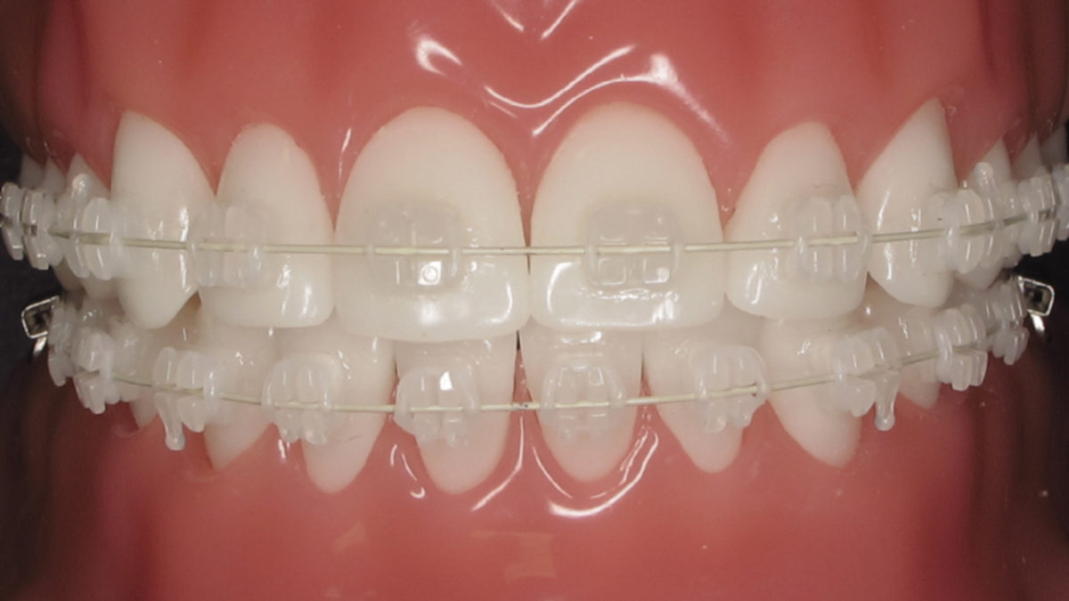 clear ceramic braces for adults