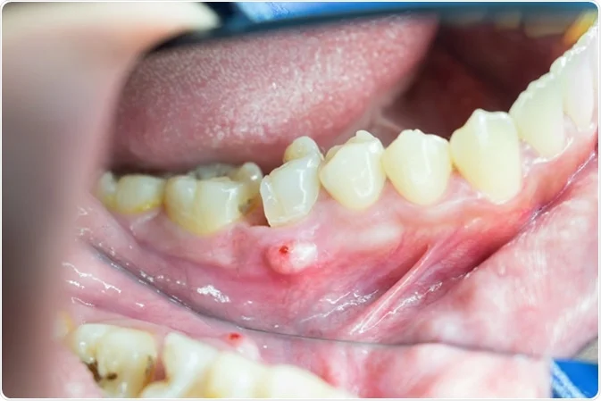 What is a tooth abscess?