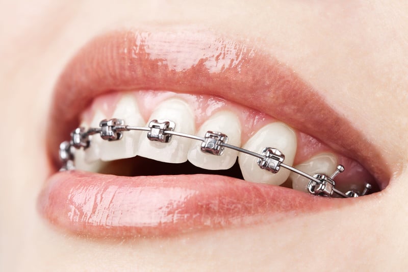 orthodontist aventura fl